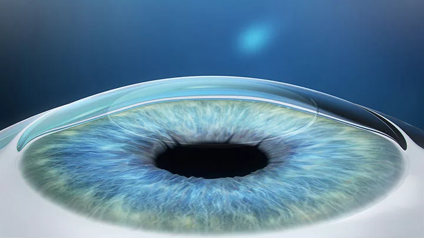 SMILE Eye Surgery